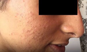 Acne / Acne Scarring — before