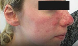 Acne / Acne Scarring — before