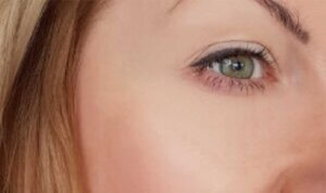 Anti Wrinkle Injections — after