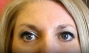 Anti Wrinkle Injections — after