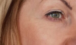 Anti Wrinkle Injections — before