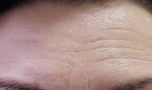 Anti Wrinkle Injections — before