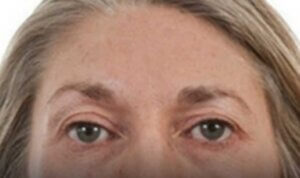 Anti Wrinkle Injections — before