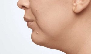 CoolSculpting — after