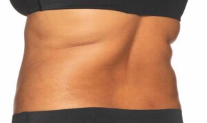 CoolSculpting — after