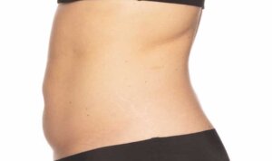 CoolSculpting — after