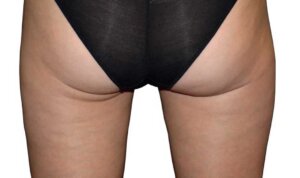 CoolSculpting — after