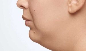CoolSculpting — before