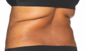 CoolSculpting — before