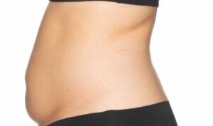 CoolSculpting — before