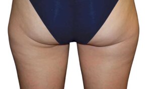 CoolSculpting — before