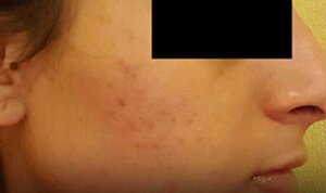 Acne / Acne Scarring — after