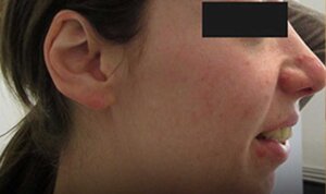 Acne / Acne Scarring — after