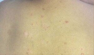 Dermalux — after