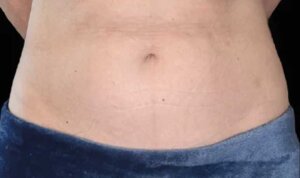 Emsculpt Neo — after