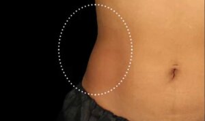 Emsculpt Neo — after