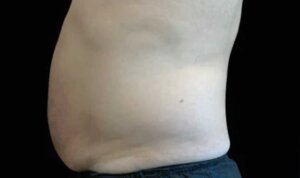 Emsculpt Neo — after