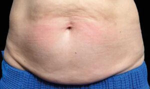 Emsculpt Neo — before