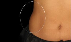 Emsculpt Neo — before