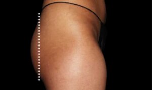 Emsculpt Neo — before