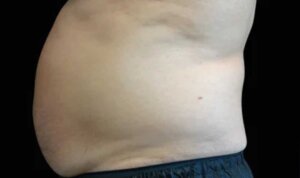 Emsculpt Neo — before
