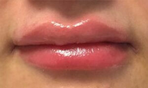 Lip Enhancement — after