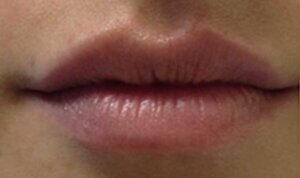 Lip Enhancement — after