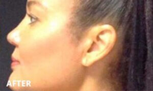 Lip Enhancement — after