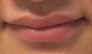 Lip Enhancement — before