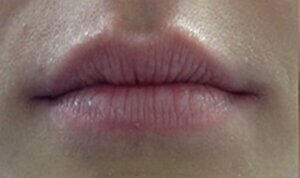 Lip Enhancement — before