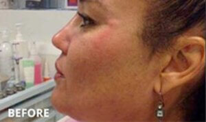 Lip Enhancement — before