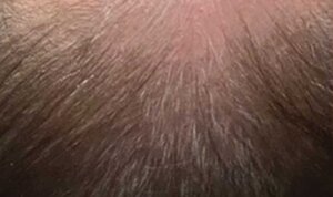 Hydrafacial Keravive — after