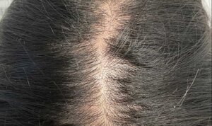 Hydrafacial Keravive — before