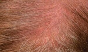 Hydrafacial Keravive — before