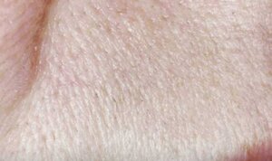 Laser Hair Removal — after