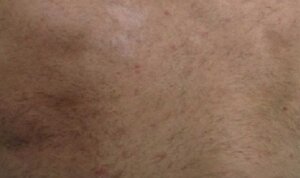 Laser Hair Removal — after