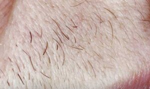 Laser Hair Removal — before