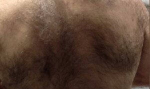 Laser Hair Removal — before
