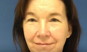 Pigmentation Reduction — after