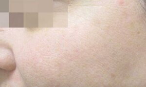 Pigmentation Reduction — after