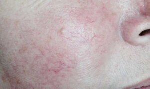 Pigmentation Reduction — after