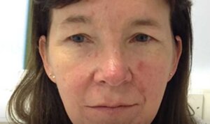Pigmentation Reduction — before