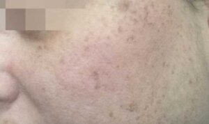 Pigmentation Reduction — before