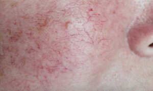 Pigmentation Reduction — before