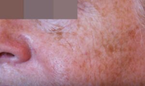 Pigmentation Reduction — before