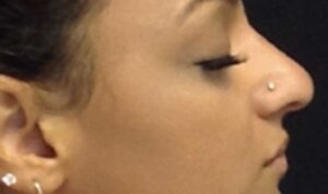 Non-Surgical Rhinoplasty — after