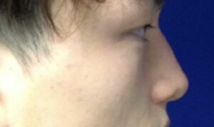 Non-Surgical Rhinoplasty — after