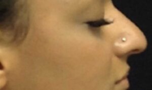 Non-Surgical Rhinoplasty — before