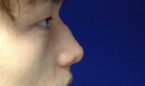 Non-Surgical Rhinoplasty — before