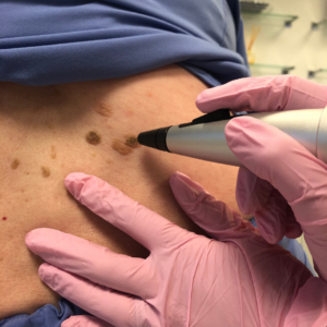 Aspire mole clinic booking now